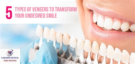 5 Types of Veneers .
